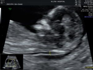 FMF CERTIFIED NUCHAL TRANSLUCENY [NT] IN TRUE MID SAGITTAL SECTION