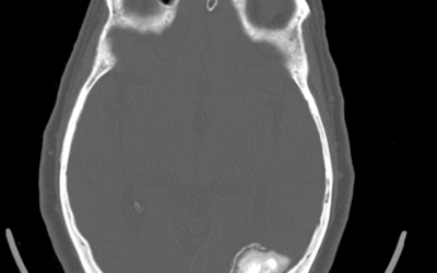 A case of atypical meningioma