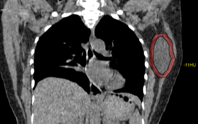 Lesion of Latissimus Dorsi muscle.