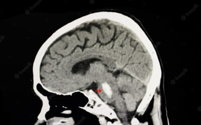 Acute Pontine Hemorrhage