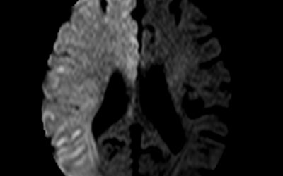 Acute Cerebral Infarct