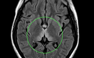 Wernicke Encephalopathy