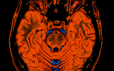 Autosomal Recessive Spastic Ataxia of Charlevoix-Saguenay