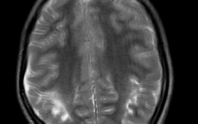 Hypoxic Ischemic Encephalopathy (HIE)