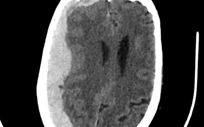 Spontaneous Non-Traumatic SDH