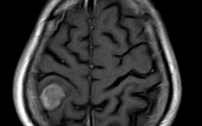 Meningioma