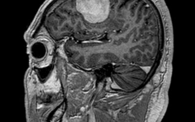 Typical Meningioma