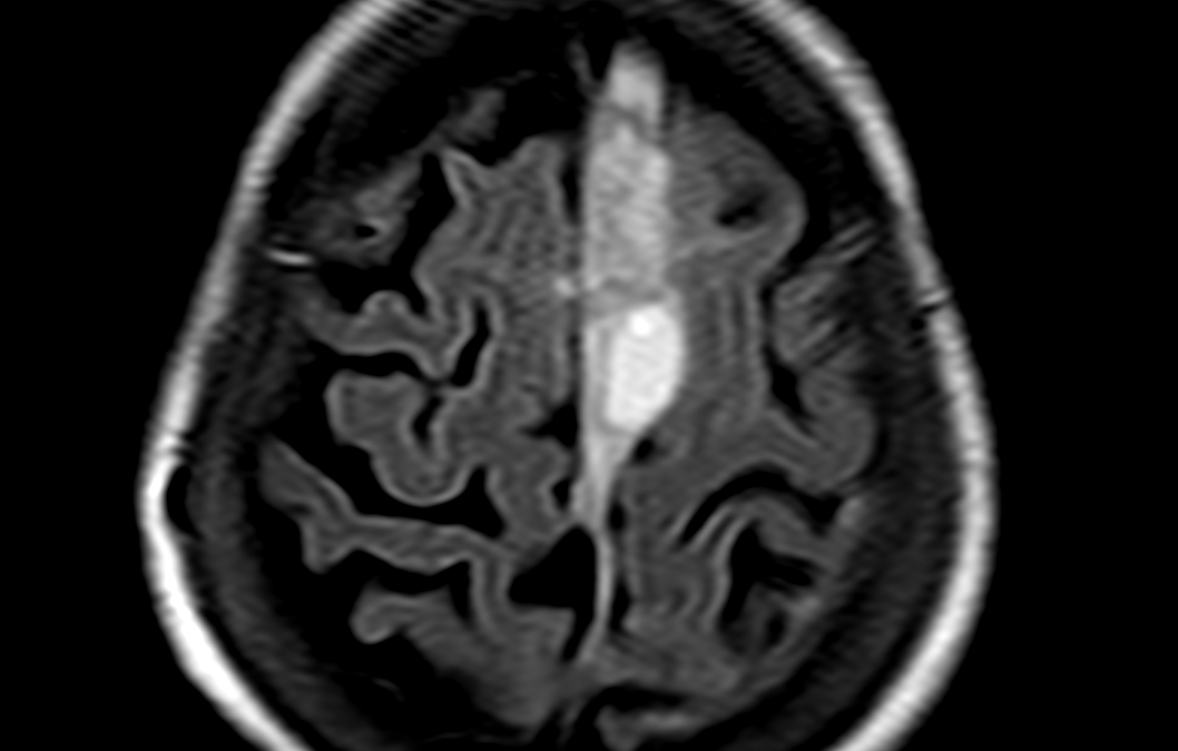 Subdural Hemorrhage MRI