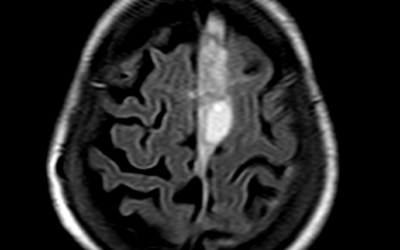 Subdural Hemorrhage MRI