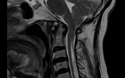 Chiari 1 Malformation with Syringohydromyelia