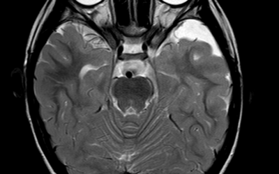 Arachnoid Cyst