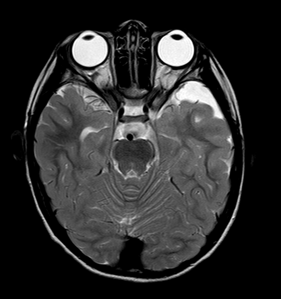 arachnoid cyst ct scan