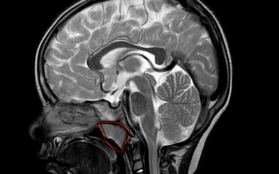 Adenoid Gland Hypertrophy