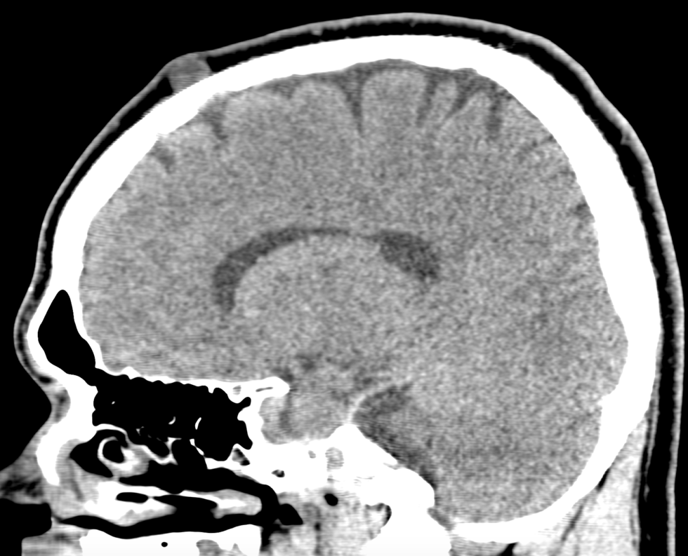 Scalp Dermoid Cyst Nr Radiology