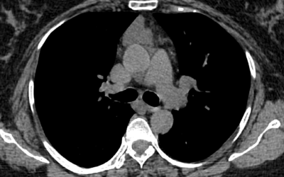 Thymic cyst