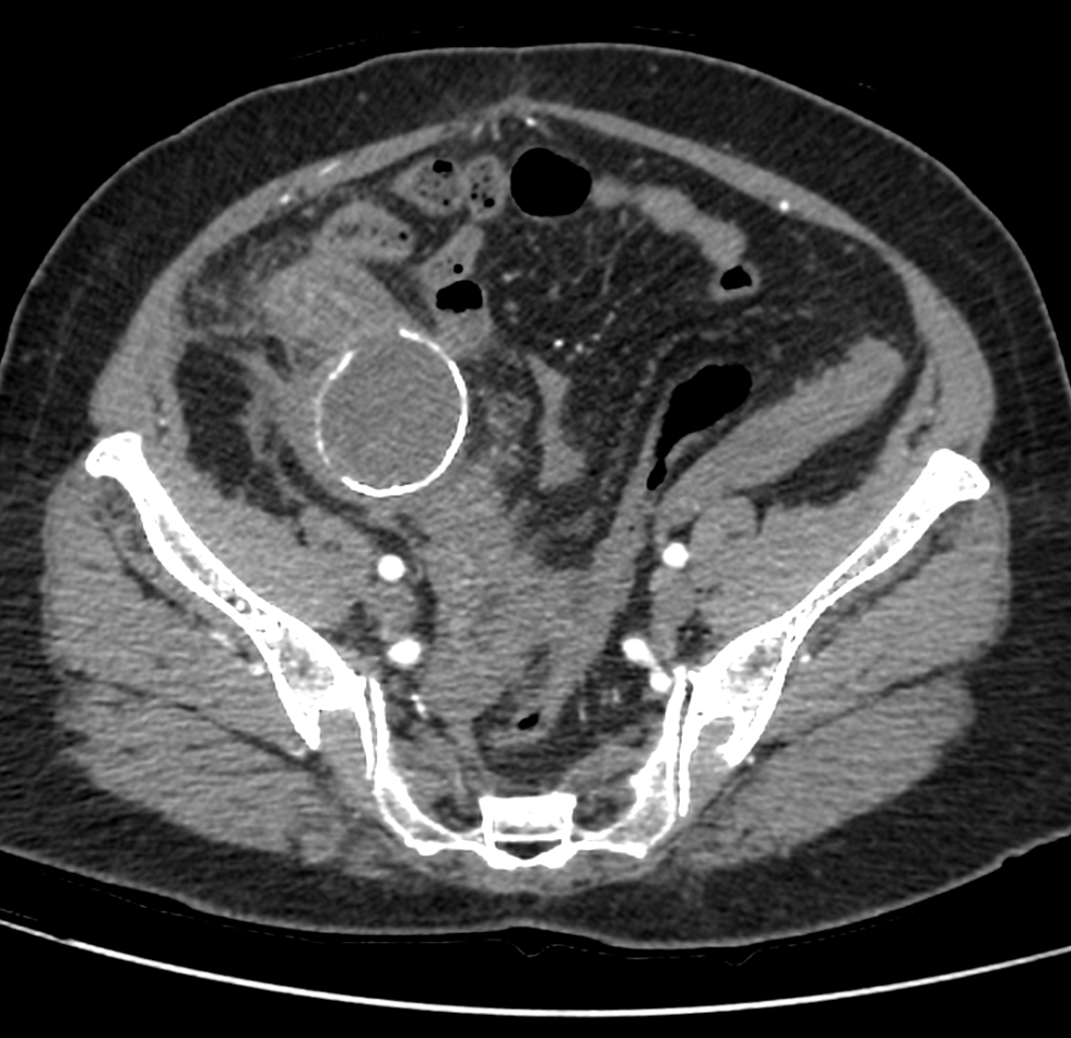 Appendiceal Mucocele Nr Radiology